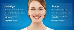 Invisalign vs braces in Long Beach California